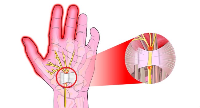 dureri articulare și constricție inflamația cartilajului articulației șoldului