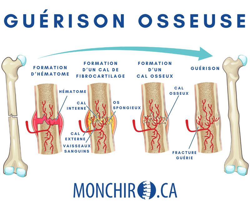Les Fractures Quelles Sont Les Causes Les Plus Communes L atelier Les Fractures Quelles Sont Les Causes Les Plus Communes L atelier